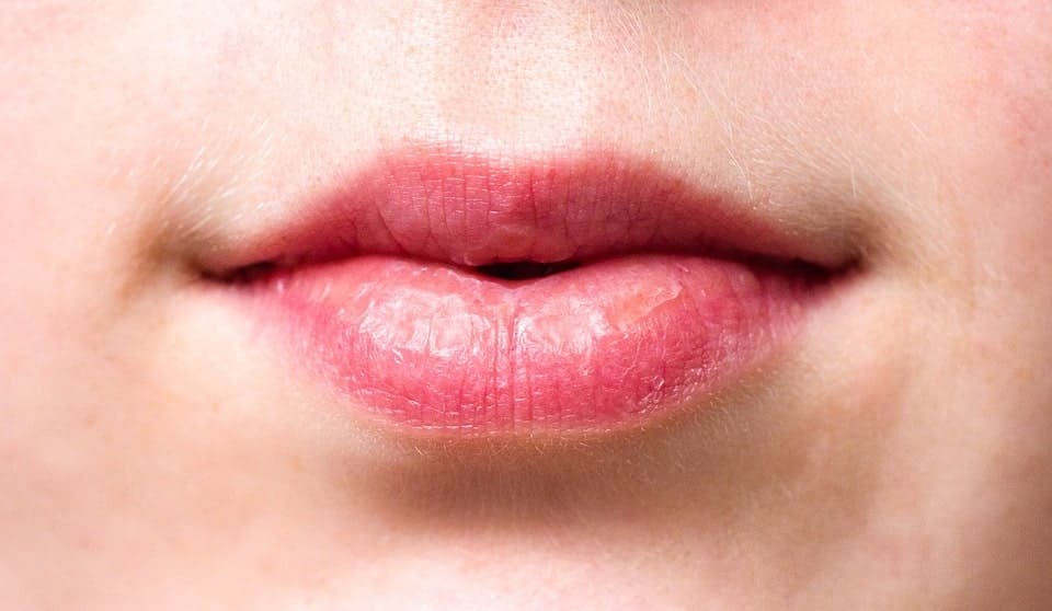 labios-ressecados Lábios ressecados: veja as possíveis causas e soluções